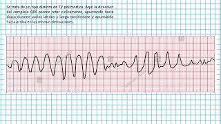 Torsades de pointes  Clases EKG 44 [upl. by Ami]