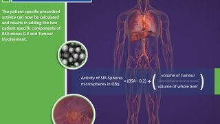 Dosimetry for SIRSpheres Y90 resin microspheres [upl. by Sheeran]