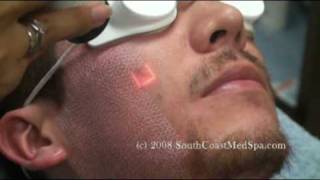 Active FX Laser Acne Scars Removal [upl. by Derrej]