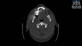 SCANNER DES SINUS Rhinite chronique avec sinusalgies [upl. by Drawets681]