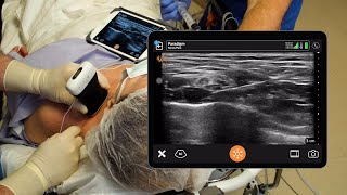 Supraclavicular Brachial Plexus Block [upl. by Woll]