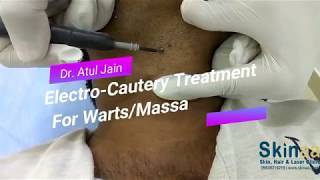 WartsMole Removal Treatment with Electrocautery in Jaipur India – Dr Atul Jain [upl. by Vasilis]