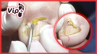 OVERGROWN INFECTED INGROWN TOENAIL REMOVAL [upl. by Ysak]