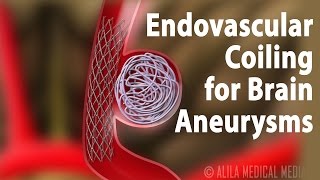 Endovascular Coiling for Brain Aneurysm Animation [upl. by Nudd]