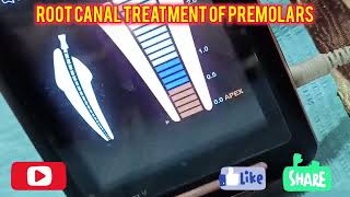 rootcanaltreatment rootcanal premolarsdentist thedentalviews dentalprocedure dentaltreatment [upl. by Quick199]