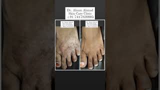 Tinea Fungal Infection Treatment By Dr Ahsan Ahmad WhatsApp No 91 7417928805 [upl. by Rusell]