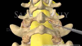 Lumbar Spine Laminectomy courtroom videos [upl. by Keyes]