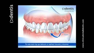 CLÍNICA DENTAL IDENTIS LA HIGIENE EN LA ALIMENTACIÓN Y EL TABACO [upl. by Walcott838]