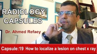 Capsule  19  How to localize a lesion on chest X ray [upl. by Nilam]