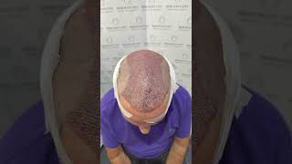 Hair Transplant Transformation 3500 Grafts [upl. by Geminius]