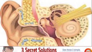 vagus nerve tinnitus treatment [upl. by Nifares]