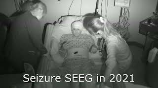 Seizure Clips of Epilepsy Progression [upl. by Hasseman]