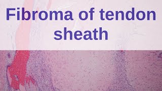 Fibroma of Tendon Sheath  Pathology mini tutorial [upl. by Madda]