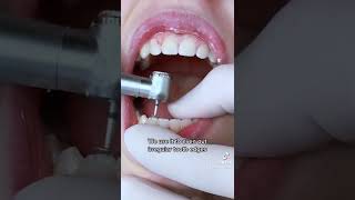 Enameloplasty  Filing Edges of Your Teeth w TheBracesDoc [upl. by Jody]