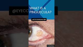 what is a pinguecula ¦eyecognizance [upl. by Akenot24]