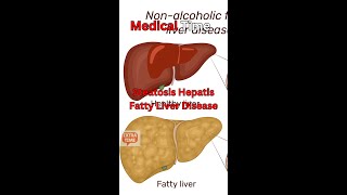 Fatty Liver Disease Steatosis Hepatis Causes Symptoms and Treatment [upl. by Eneleahcim]