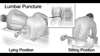 Mnemonics to remember structures pierced during Lumbar Puncture [upl. by Aneek]