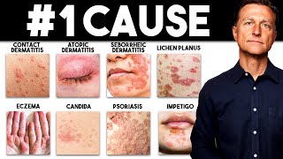 The MOST Common Deficiency in All Skin Diseases Dermatitis [upl. by Mirilla455]