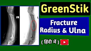 GreenStick Fracture of Radius amp Ulna  GreenStick Fracture in Children  XRay ForeArm  UdayXray [upl. by Sone]