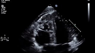 Arrhythmogenic Right Ventricular DysplasiaCardiomyopathy [upl. by Mikes]