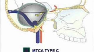 PETROCLIVAL MENINGIOMA DECISION MAKING [upl. by Asenej]