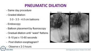 Achalasia Inject Dilate or Surgery [upl. by Leamaj]