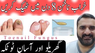 خراب ناخن کا علاج  Nail Fungus Healthmatters22 healthtips Healthmatters22 DrKhurram [upl. by Imiaj]