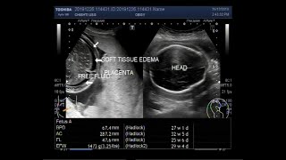 Ultrasound Video showing scanning of Pregnancy of about 28 weeks with fetal demise [upl. by Darlene119]