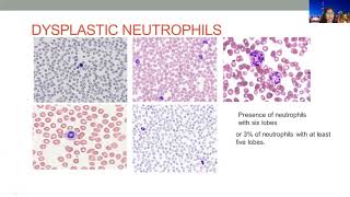 LG PathLab webinars  Myelodysplastic syndrome  An approach including case based discussions [upl. by Wini127]