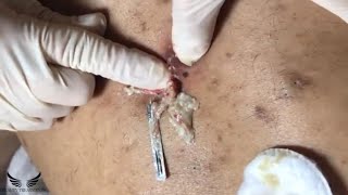 Cystic Acne Treatment  Blackhead Removal  Back Pimple Popping  Hidden Acne Spa Relaxing  096 [upl. by Aleksandr]