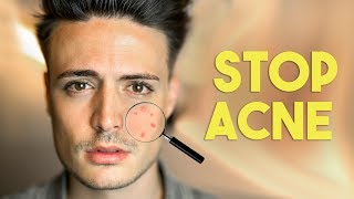 Stop Acne FAST 5 Steps to beating acne FOREVER [upl. by Ainniz]