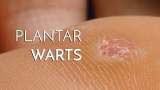 Plantar Warts Verrucas  Podiatrist Georgina Tay East Coast Podiatry [upl. by Laon]