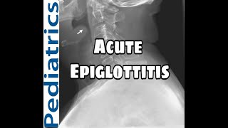 Acute Epiglottitis  Causes  Clinical features  Diagnosis and Treatment MED BABY In HINDI [upl. by Rehpotsyrk]