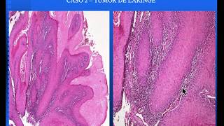 SEMINARIO I  VARIANTES CARCINOMA EPIDERMÓIDE  PARTE I [upl. by Eillit264]