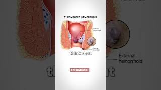 Hemorrhoids What is the Cause [upl. by Aennil]