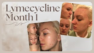 ACNE MONTH 1 ON LYMECYCLINE [upl. by Wightman]