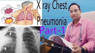 Part1 Pneumonia X ray Chest me kaise pahchane [upl. by Oretos]