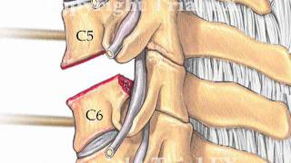 Anterior Cervical Discectomy and Disc Arthroplasty [upl. by Aserat]