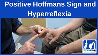 Positive Hoffmans Sign and Hyperreflexia [upl. by Aititel]