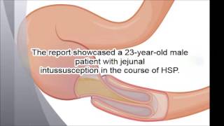 Abdominal pain manifesting intussusception in a rare adult HenochSchönlein purpura [upl. by Arodoet443]