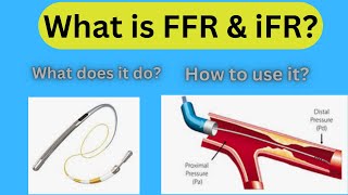 What is FFR 0r iFR How does it work [upl. by Yerfoeg]