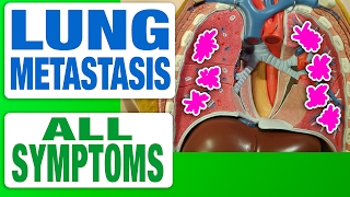 Lung Metastasis  All Symptoms [upl. by Alyks]