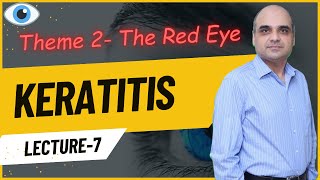 Keratitis Lecture 7 [upl. by Derfiniw]