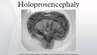 Holoprosencephaly [upl. by Ahtnahc138]