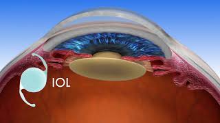 Florida Eye  LENSAR Laser Assisted Cataract Surgery [upl. by Zetrac]