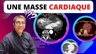 Une masse dans le VD  thrombus métastase ou tumeur primitive  Comment raisonner sur le SCANNER [upl. by Gardia]