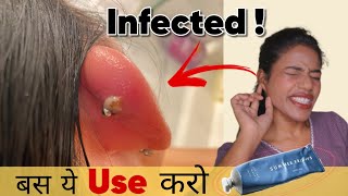 How to Heal Infected Ear Piercing Faster  100 Result  Ravinaa Gupta [upl. by Gnilyarg]