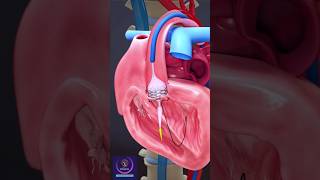 Heart Stent Aortic Valve Repair with angioplasty shorts heartstent [upl. by Yelah]