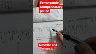 compensatory pause shorts physiology [upl. by Drusy]