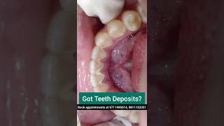 Got Teeth Deposits Get UltraSonic Scaling done Dr Srishti Bhatia teeth scaling [upl. by Pyotr319]